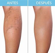 Pack 6 sobres Parches De Pierna Para Varices